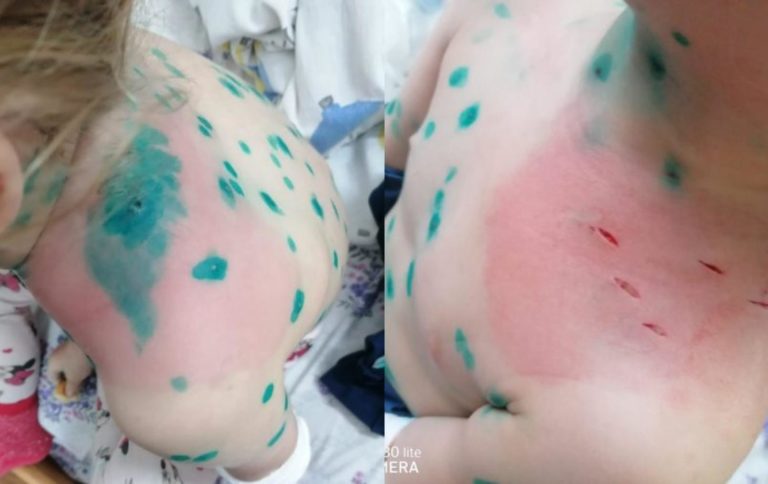 (ФОТО) В Кишинёве мать 4-летней девочки пожаловалась на медперсонал больницы. Реакция Минздрава
