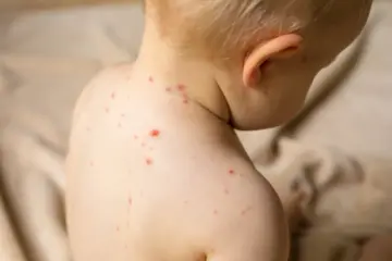 Младенец, болеющий корью с сыпью на спине